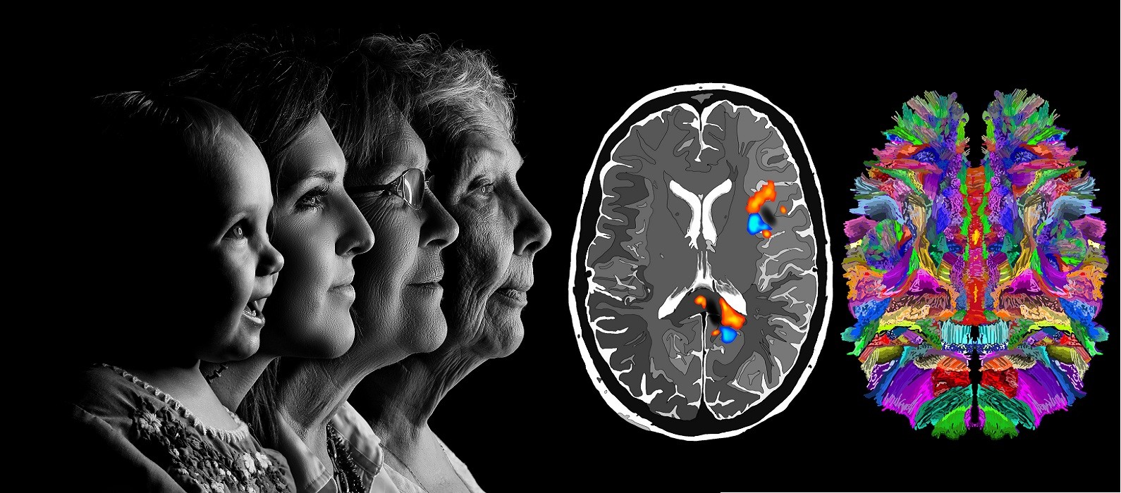Пройти тест на болезнь Альцгеймера в картинках: какие ваши риски?