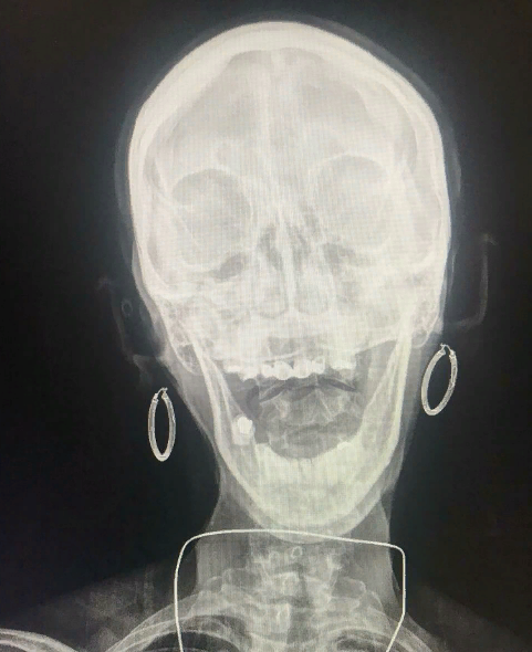 10 занимательных рентгеновских снимков и интересных фактов об «Х»-лучах